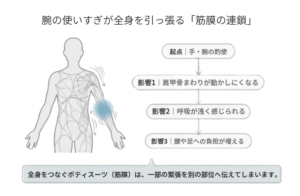 腕の使いすぎが筋膜を通じて全身へ伝わる流れを表したイメージ